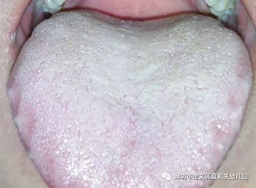 小孩舌苔厚白是怎么回事_厚小孩回事舌苔白是上火嗎_厚小孩回事舌苔白是什么原因