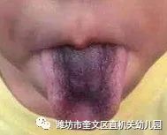 厚小孩回事舌苔白是什么原因_小孩舌苔厚白是怎么回事_厚小孩回事舌苔白是上火嗎